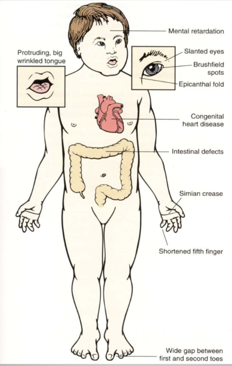 <p>Chromosomal disorder with characteristic facial features, intellectual disability, simian crease, congenital heart disease, etc.</p>