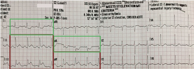 <p>1+ mm ST elevation in 2 or more contiguous leads w/ reciprocal changes</p>