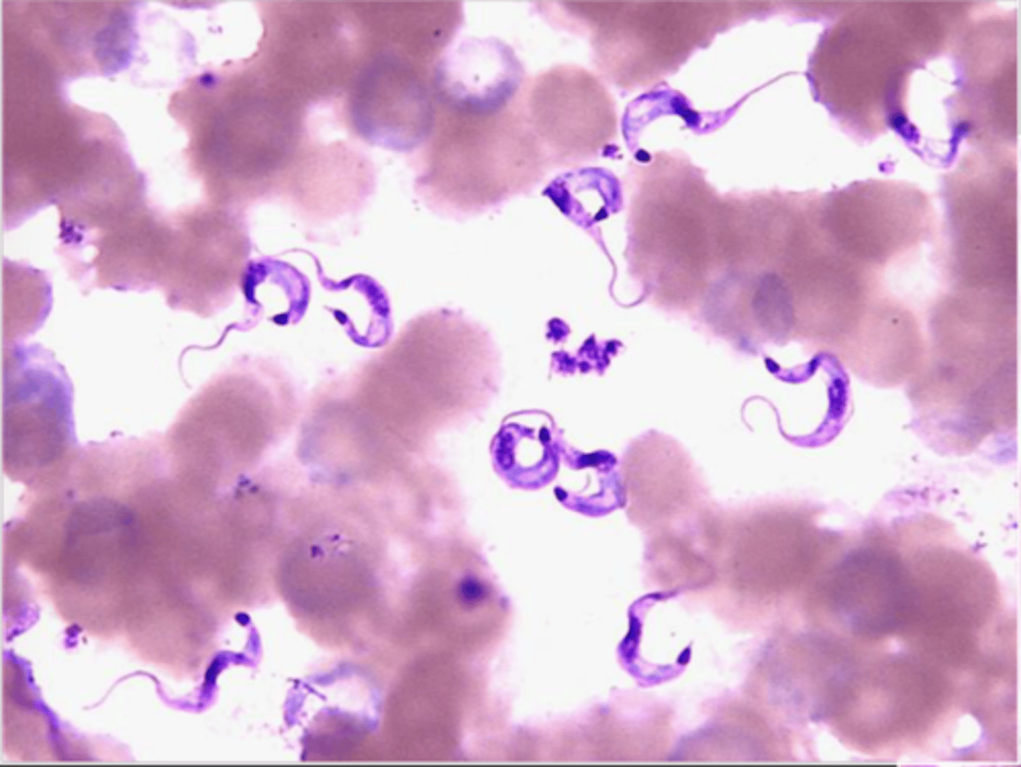 <p>Chagas disease</p>