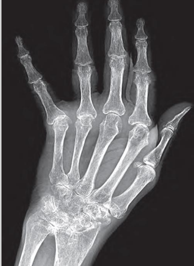 •Diffuse osteopaenia •Marked loss of joint spaces of the carpal, metacarpal, phalangeal and interphalangeal joints •Periarticular bony erosions •Ulnar drift of fingers