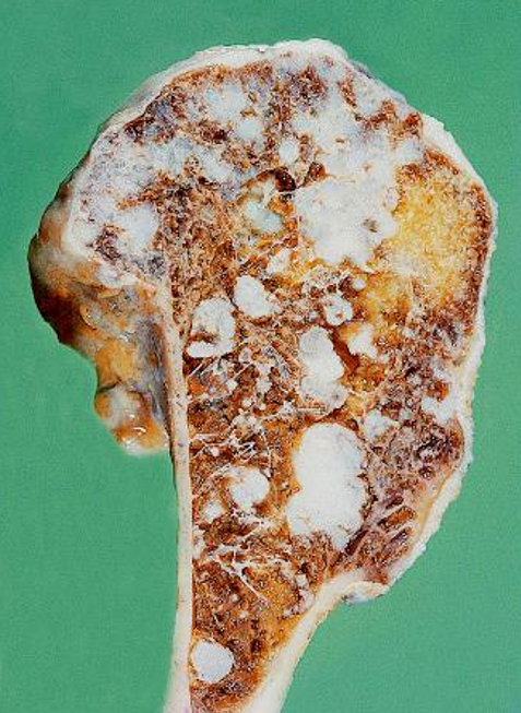 <p><strong><span style="color: red">enchondromatosis</span></strong> - benign, multiple growths of cartilage (enchondromas) </p>