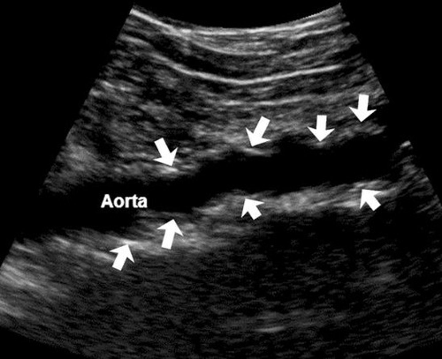 <p>A type of arterial disease where the inner lining of arteries thickens due to fatty deposits, carbohydrates, blood components, calcium, and fibrous tissue.</p>