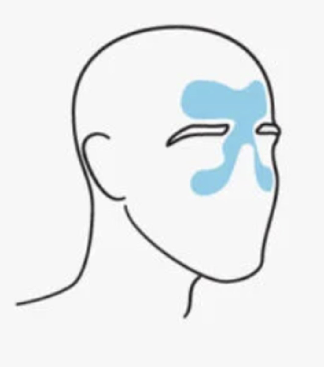 <p>infection or blockage of the sinuses, resulting in inflammation &amp; distention of the sinus walls--&gt; pain &amp; sensitivity</p>