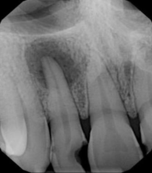 <p>T/F one can determine from this periapical if the lesion. is a periapical granuloma or cyst </p>