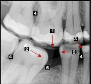 <ol><li><p>super-eruption → root + furcation exposure </p></li><li><p>molar tipping → pseudopocket (5)</p></li><li><p>open contact </p></li></ol><p></p>