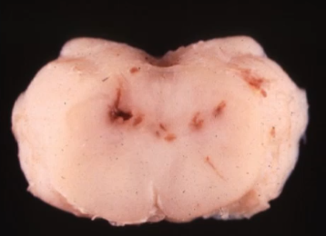 <p>what type of hemorrhage is this?</p>