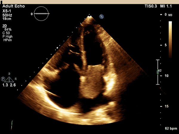<p><span><span>What cardiac condition is demonstrated in this image?</span></span></p><p>Rhabdomyosarcoma</p><p>LA thrombus</p><p>LA myxoma</p><p>Lipoma</p><p>Angiosarcoma</p>