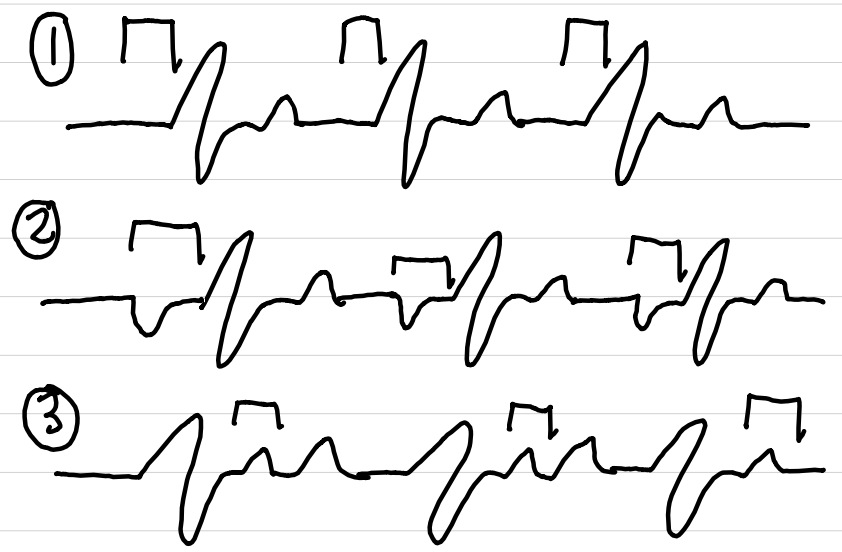 <p>AV junction is pacemaker</p><ul><li><p>P wave may be absent (1), inverted (2), or after QRS (3)</p></li><li><p>QRS normal</p></li></ul><p></p>