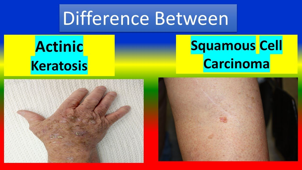 <p><strong>B. Squamous Cell Skin Cancer</strong></p><div data-type="horizontalRule"><hr></div><p><strong>Decreases risk </strong>of <strong>actinic keratoses </strong>→ which is a precursor to SKIN CA. Melanoma may not be reduced with sunscreen</p>