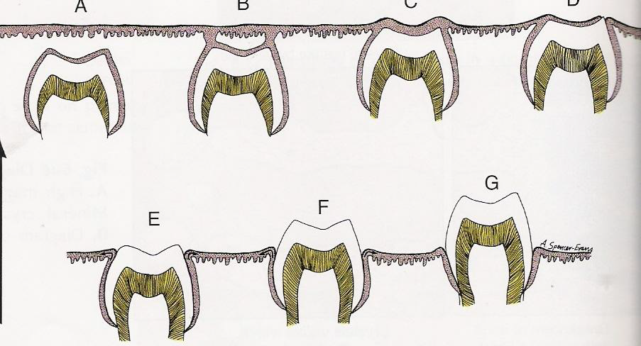 <p>Q: Describe Stage G of the Stages of Tooth Eruption.</p>
