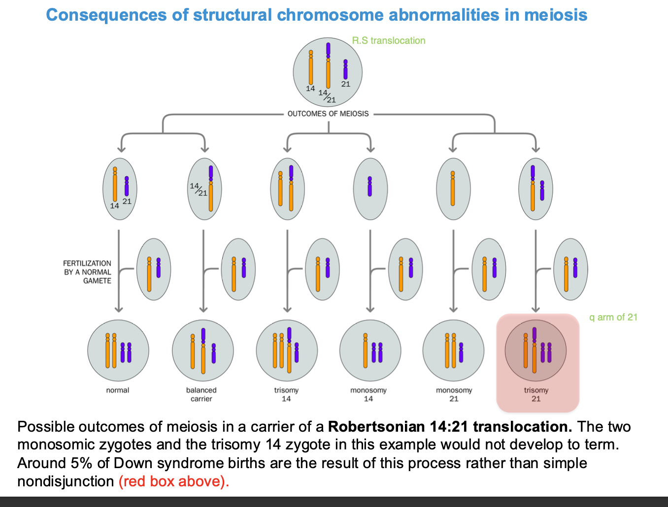 <p>(remember meoisis is where the abnormality is detected BECAUSE chromosomes are not homologous to fuse together - so only fuse partially </p><p>-CAUSING ANEUPLOIDY - trisomy / monosomy </p><p>ROBERTSONIAN 14:21 - TRANSLOCATION </p><p><strong>Robertsonian</strong> = acrocentric chromosomes </p><p>5% of downsyndrome - due to ROBERTSONIAN TRANSLOCATION </p><p>aneuploidy - chromosome 14 is translocated to chromosome 21</p><p>trisomy </p><p></p><p></p>