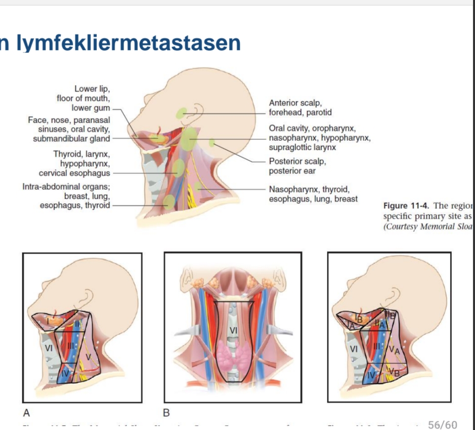 <p>Regio’s 1 tot 5 bilateraal<br>Verspreidingspatronen<br></p><p>Bij radiochemotherapie: <br>bestraling van de hals<br></p><p>Bij heelkunde: <br>halsklieruitruiming = <br>halsevidement = neck<br>dissection</p>