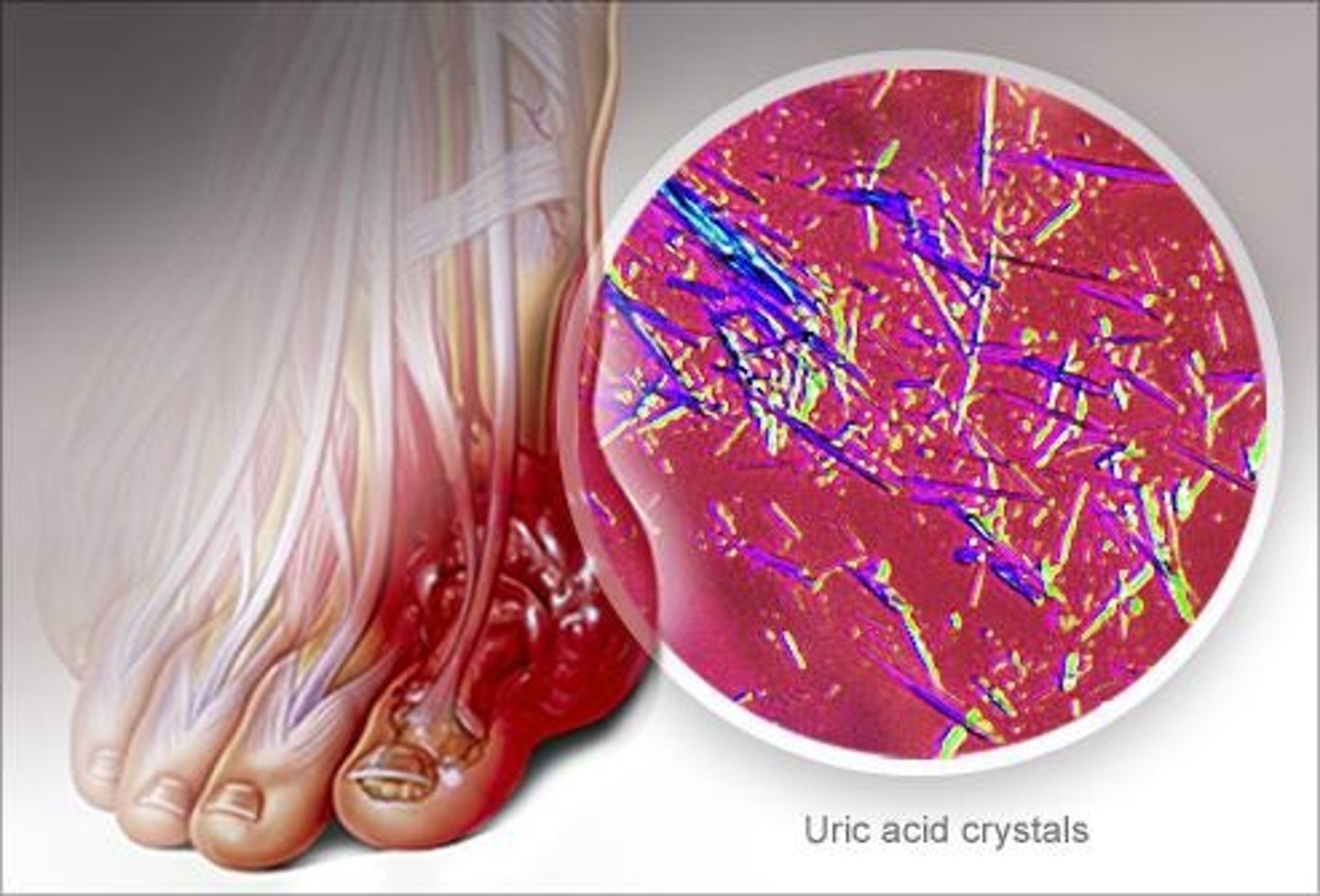 <p>SNPs in ABCG2 are associated with a higher risk of gout, particularly in males.</p>