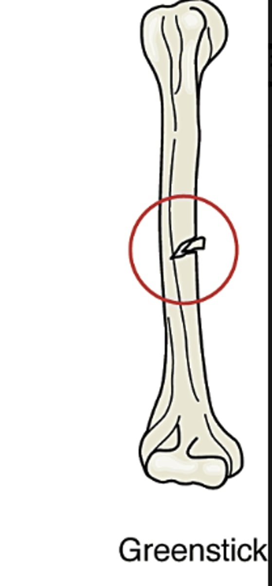 <p>Bone is bent and fractures on the outer arc of the bend. Often seen in children.</p>