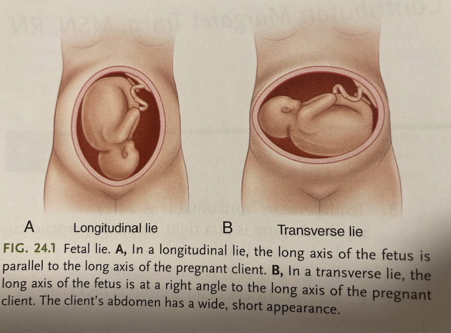 <p>relationship of the spine of the fetus to the spine of the pregnant person.</p>