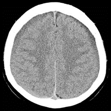 <p>A 65-year-old female presents with her daughter and the chief complaints of headache, weakness and confusion. She is oriented to her name, but not the date or place; she can recall 1 of 5 items after 5 minutes. Physical examination reveals papilledema.  Her muscle stretch reflexes are globally 3+; she has bilateral Babinski and Hoffman signs and pronator drift. A CT scan reveals the accompanying image. What is the most likely diagnosis?</p><p></p><p>A. Epidural hematoma</p><p>B. Intraparenchymal hemorrhage</p><p>C. Intraventricular hemorrhage, lateral ventricle</p><p>D. Intraventricular hemorrhage, third ventricle</p><p>E. Subarachnoid hemorrhage, ambient cistern</p><p>F. Subarachnoid hemorrhage, cisterna magna</p><p>G. Subdural hematoma, acute</p><p>H. Subdural hematoma, chronic</p>