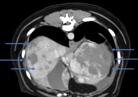 <p>non-ruptured masses or nodules found with diagnostic imaging are more commonly benign</p>
