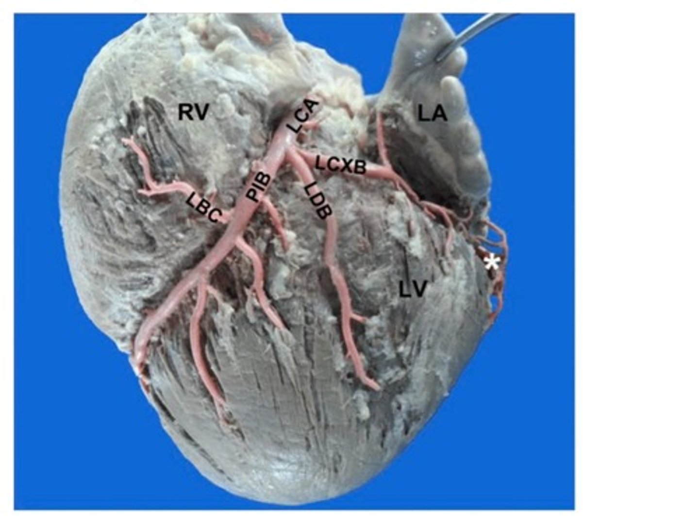 <p>Small red arteries on the surface of the heart.</p>