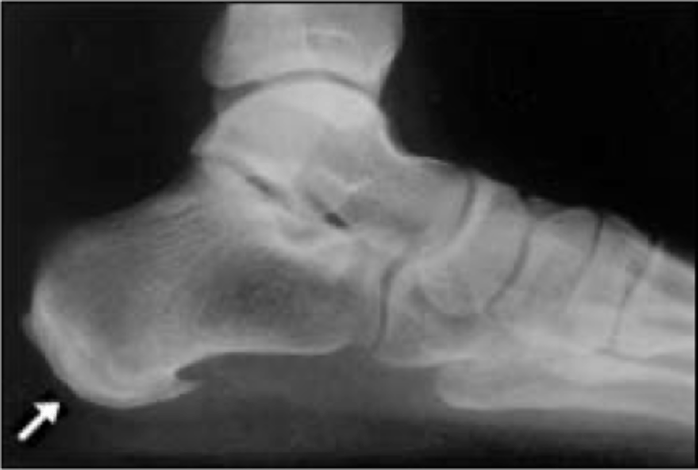 <p>With osteoarthrosis of the ankle, an _____ can be seen in the calcaneus</p>