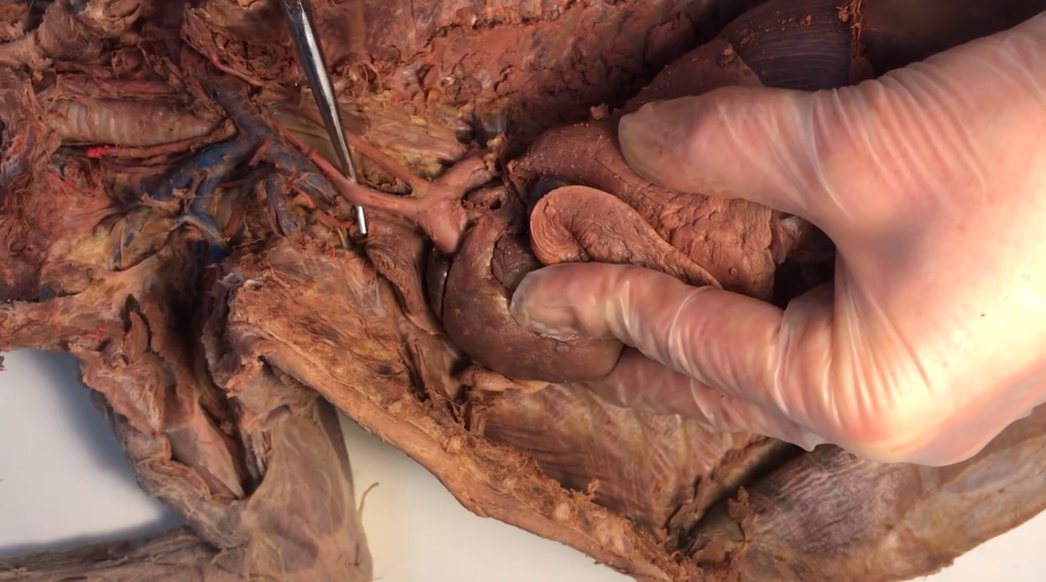 <p>What artery is this</p>