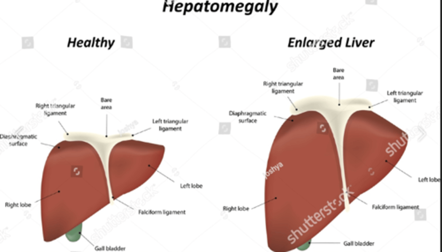 <p>A</p><p>A</p><p>The term hepatomegaly refers to an enlarged liver. The term splenomegaly refers to an enlarged spleen. The other responses are not correct.</p>