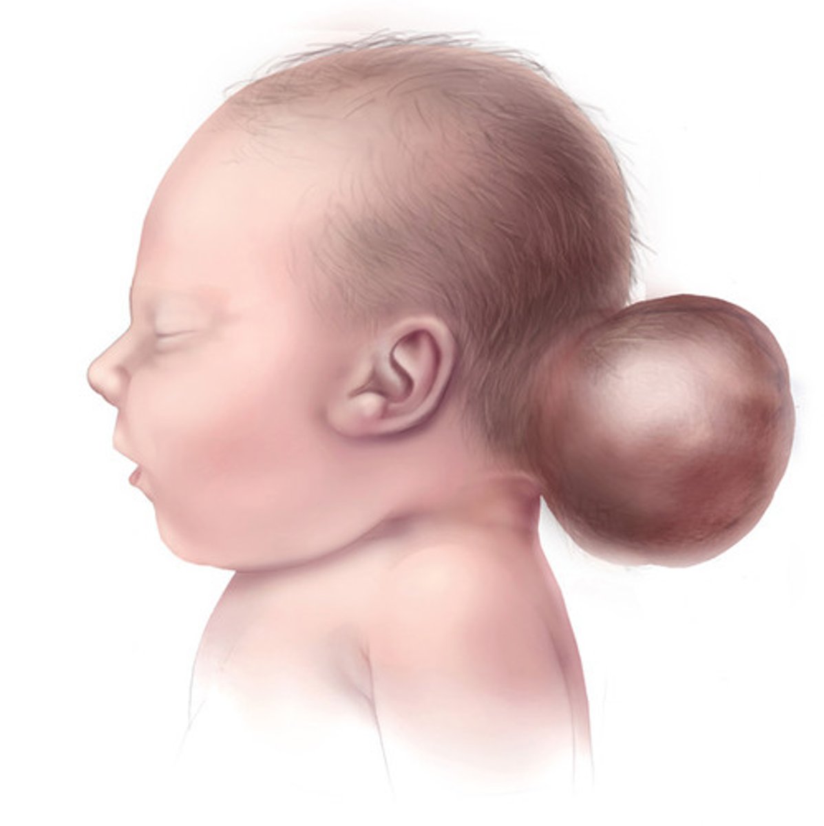 <p>A condition usually occurring in the occipital region, where brain tissue protrudes through a defect in the skull.</p>