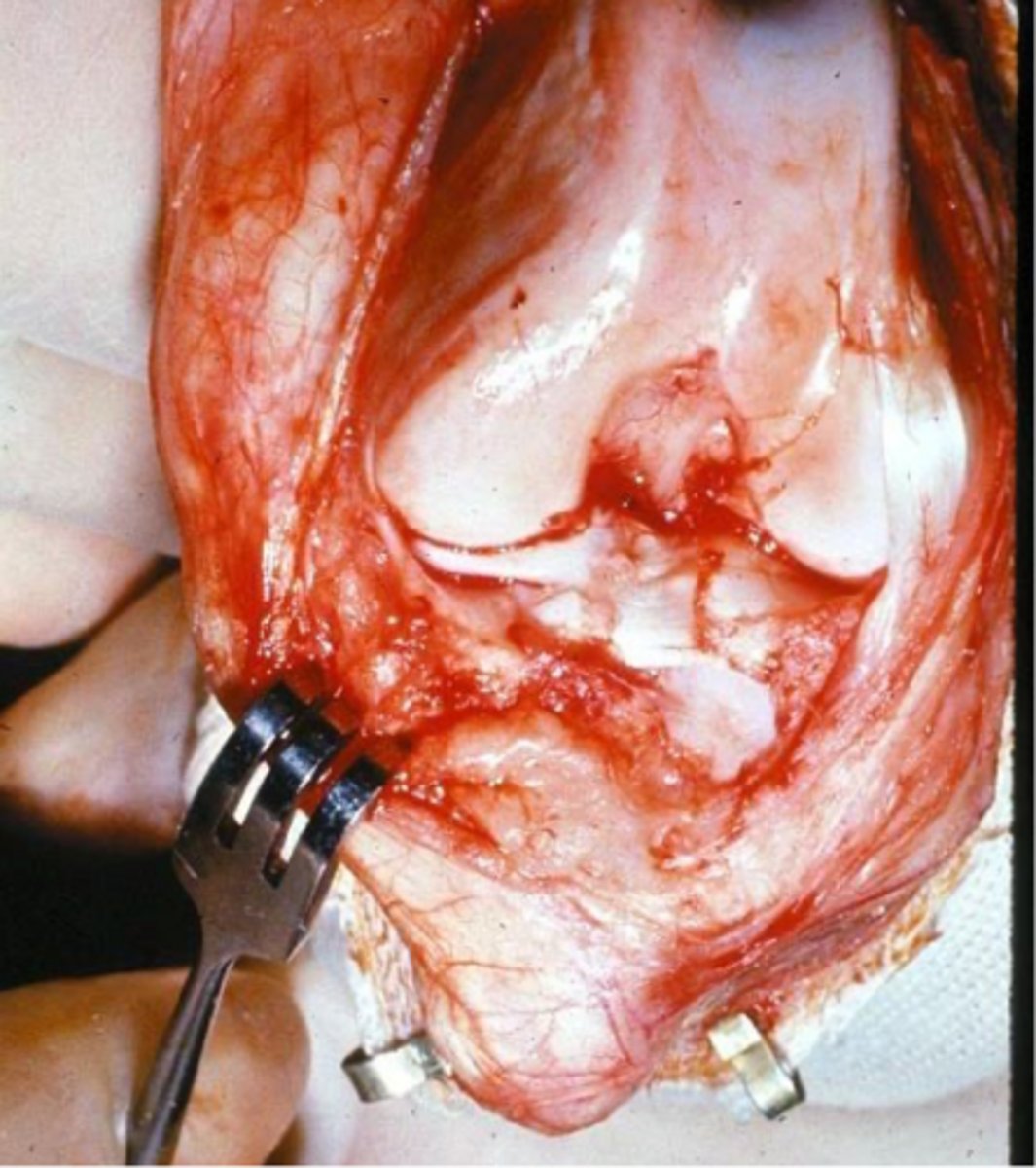 <p>we should perform ____ on all surgical cases for CCLD</p>