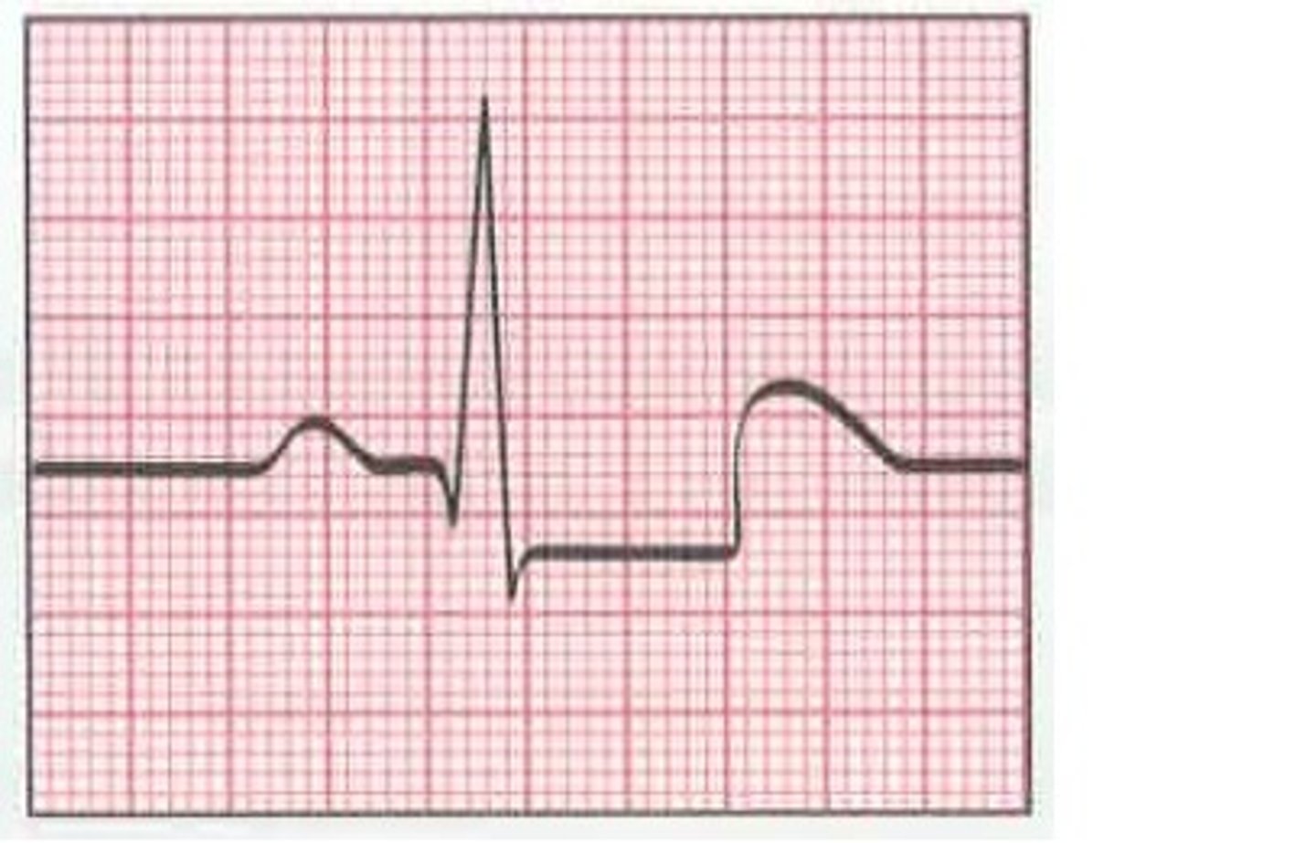 <p>-transient thrombosis or incomplete coronary artery occlusion (partial)</p><p>-partial wall thickness damage</p><p>-ST-segment depression</p><p>-called a Non ST-Segment Elevation MI (NSTEMI)</p>