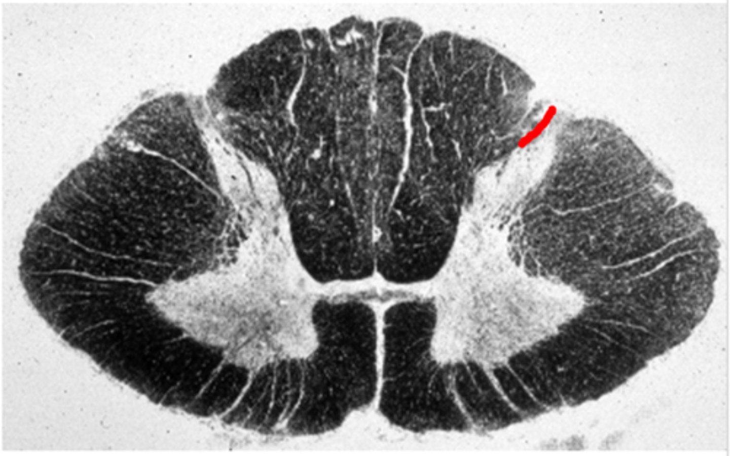 <p>Entry zone for the dorsal roots</p>
