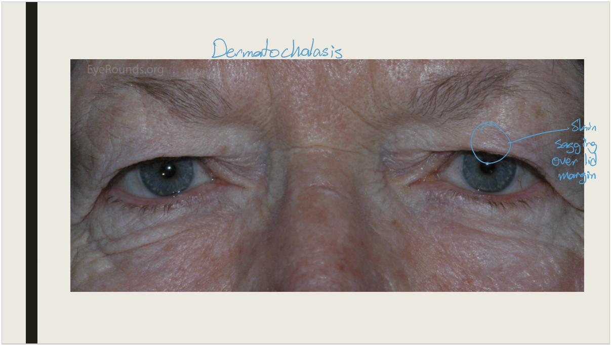 <ul><li><p>Lack of support seen with deficit of orbit volume-prosthetic eye</p></li><li><p>Contralateral lid retraction</p></li><li><p>brow ptosis</p></li><li><p>dermatochalasis (most common) </p></li></ul><p></p>