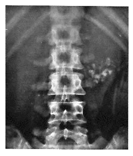 <p>64yo, hx smoking, drinks 2 martinis daily, with 6month hx of midepigastric pain with eating &amp; weight loss. telangiectasias over chest</p>