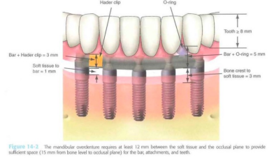 Space requirements for implant-supportive OD