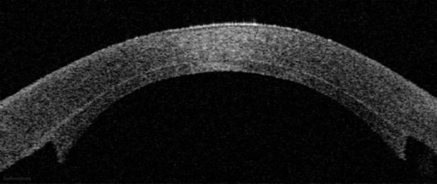 <p>What are the 3 main optical drawbacks of DSAEK?</p>