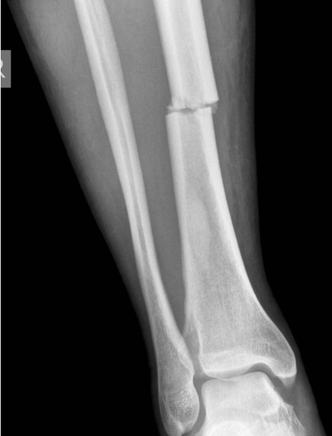 <p><span>Identify the type of fracture present in the x-ray of this tibia.</span></p>