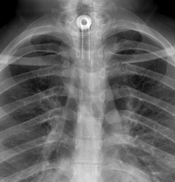 <p><span>distal tip is positioned at midpoint between the upper end of the tube and the carina, typically <strong>6cm above the carina</strong></span></p>