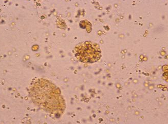 <p>RTE reabsorbed hemosiderin from glomerular filtrate and sloughed off into urine</p>