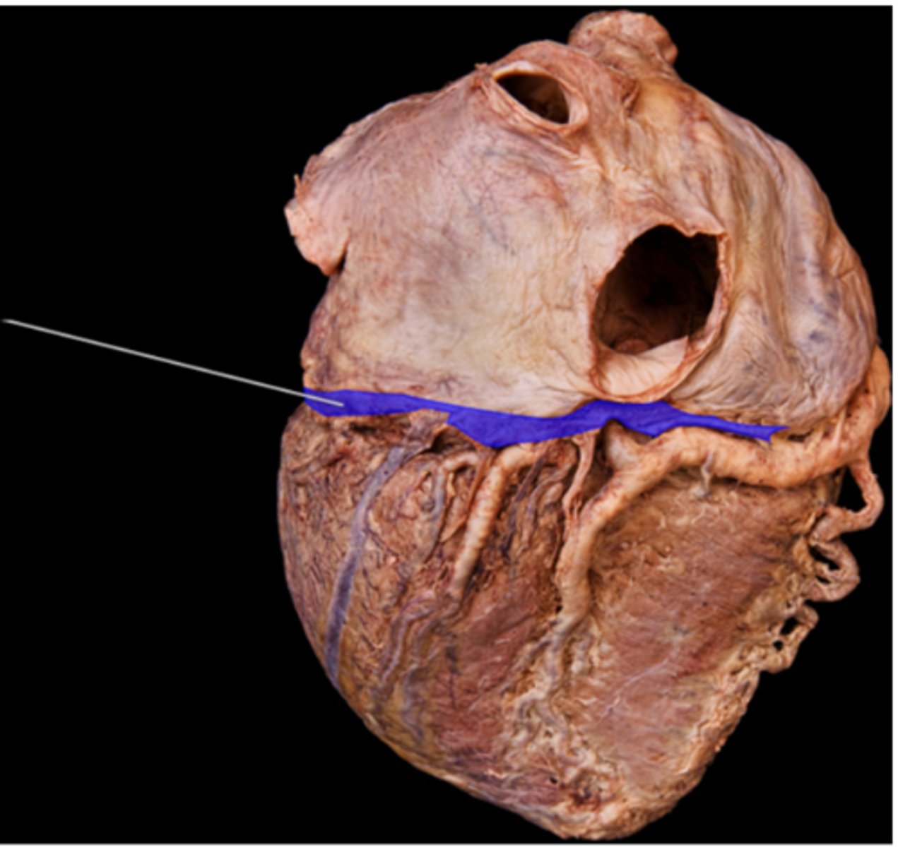 <p>coronary sinus</p>