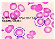 <p><span style="background-color: transparent; font-family: "Times New Roman", serif;">*Complete blood count: decreased MCV and MCHC</span></p><p><span style="background-color: transparent; font-family: "Times New Roman", serif;">*Peripheral blood smear: <strong>hypochromic </strong>(paler)<strong> micocytic </strong>(smaller than nucleus of lymphocytes)</span></p><p><span style="background-color: transparent; font-family: "Times New Roman", serif;">*Reduced blood iron levels</span></p>