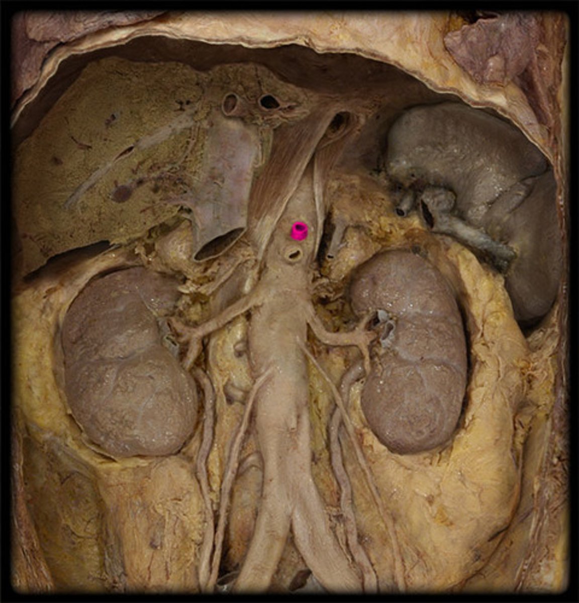 <p>Abdominal aorta</p>
