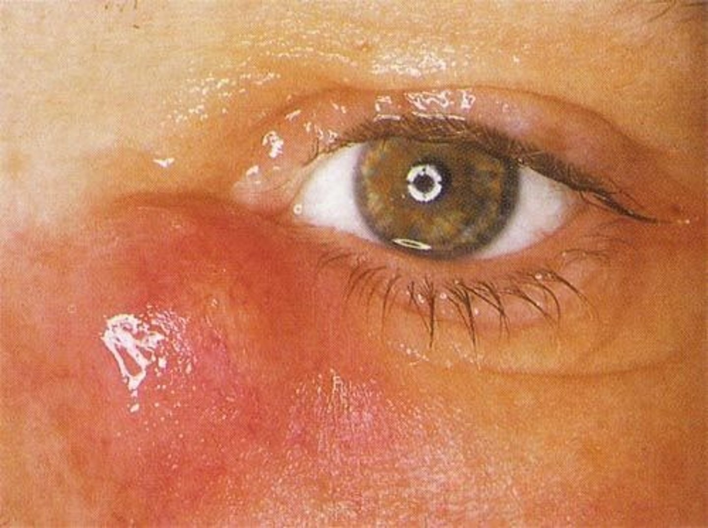 <p>Dacryocystitis is infectious obstruction of the nasolacrimal duct (inferomedial region)</p>