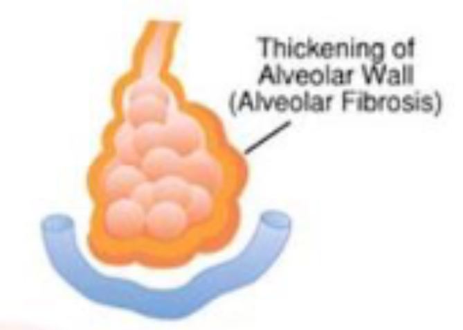 <ul><li><p>thickening of alveolar wall</p></li><li><p>higher diffusion distance→ less O<sub>2 </sub> in lungs</p></li></ul><p></p>