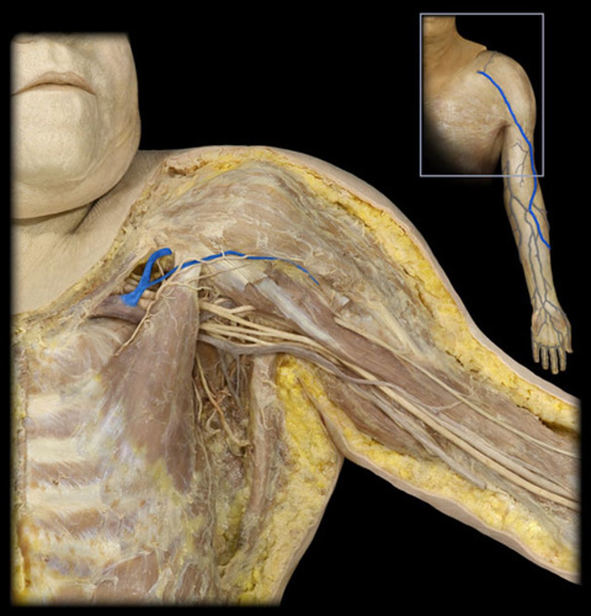 <p>separates the pectoralis major and deltoid muscles</p>