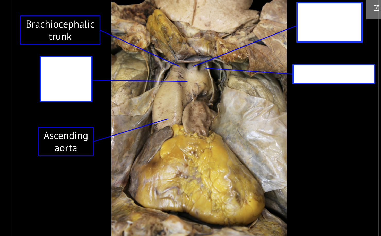 <p>bottom right (artery)</p>