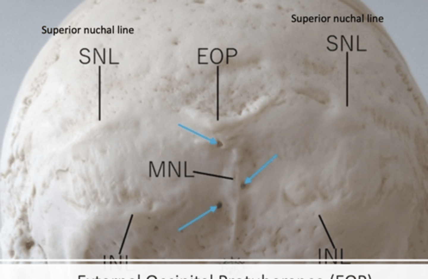 <p>SNL (superior nuchal line)</p><p>MNL (medical nuchal line)</p><p>INL (inferior nuchal line)</p><p>EOP (external occipital protuberance)</p>