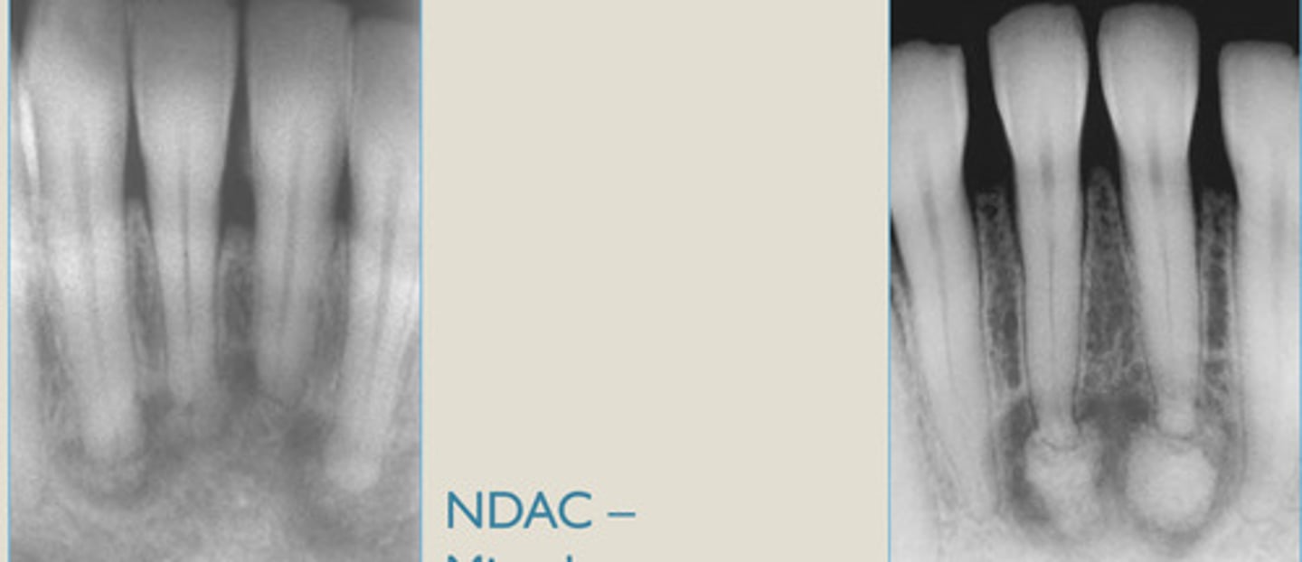 <p>Which ones the mixed stage (2nd) vs the mature stage (3rd)?</p><p>Confined to anterior mandible, no symptoms, Lucent to opaque migration.</p>