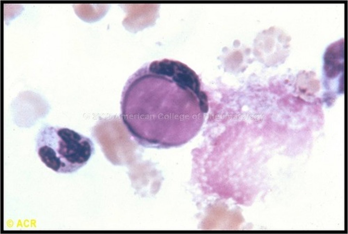 <p>* L for lupus<br>-seen in other autoimmune diseases<br>-Cells with the nuclei of other cells phagocytized inside<br>-Usually in CSF<br>- Allowed for 1st "anti-nuclear antibody test" to detect autoimmune disorders</p>
