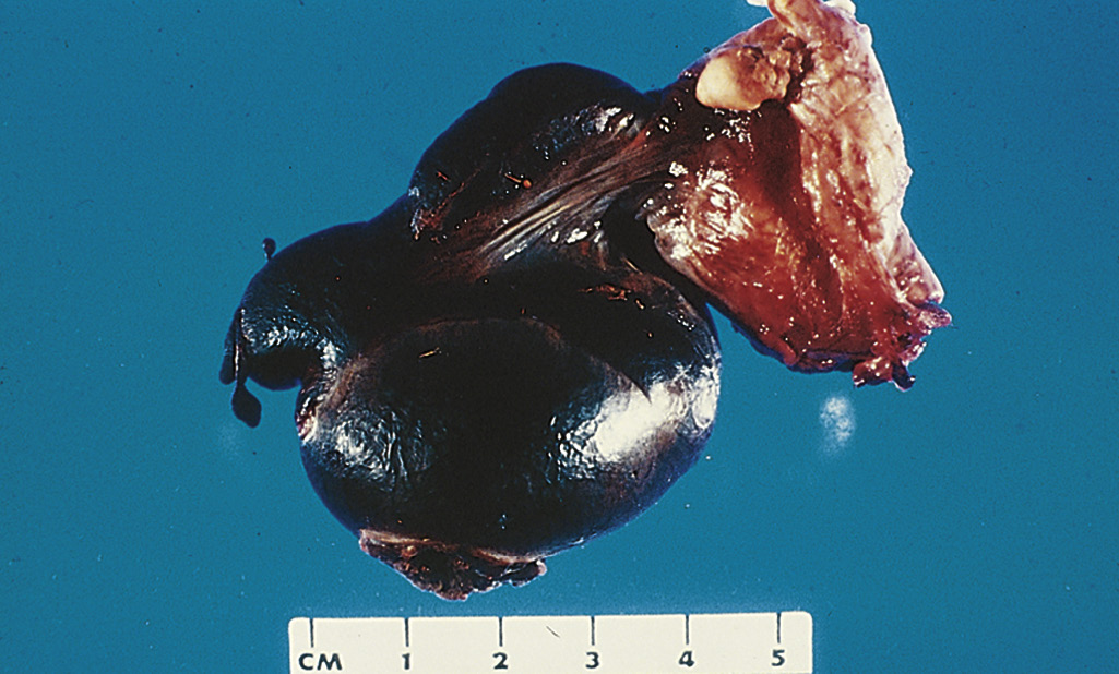 <p>A 23-year-old, previously healthy man suddenly develops severe pain in the scrotum. The pain continues unabated for 6 hours, and he goes to the emergency department. On physical examination, he is afebrile. There is exquisite tenderness of a slightly enlarged right testis, but there are no other remarkable findings. The gross appearance of the right testis is shown in the figure. Which of the following conditions is most likely to cause these findings?</p>