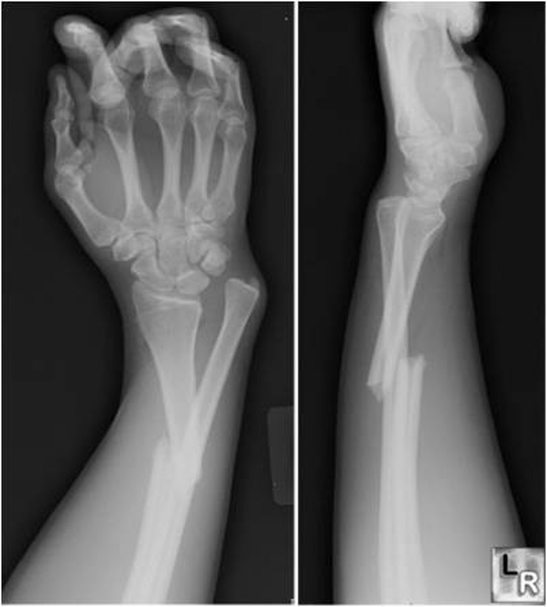 <p>galeazzi fracture</p>