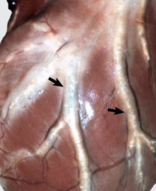 <p>What blood vessel condition is predisposed for by Virchow’s triad, and is caused by primary endocarditis (left side thromboembolism), or atherosclerosis of the coronary arteries? Lesions appear as pale areas on the myocardium which will be collapsed and firm if it is chronic. Cardiac failure, secondary abscessation, scarring, and myocardial infarction can result.</p>