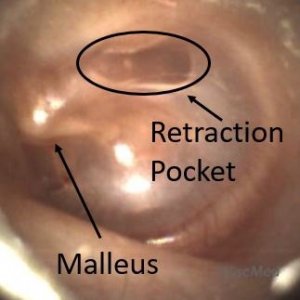 <p>retraction pocket of tympanic membrane (pulled into middle ear)</p>